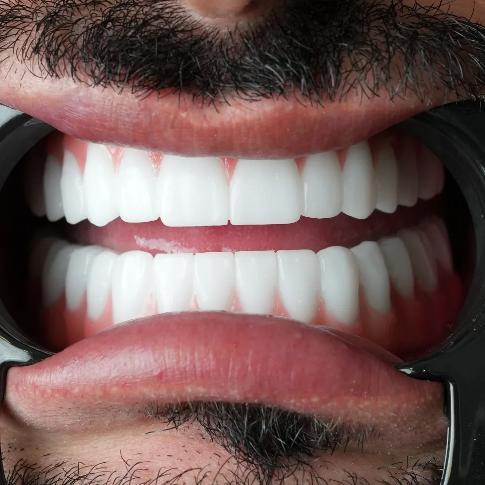 ZIRCONIUM CROWNS